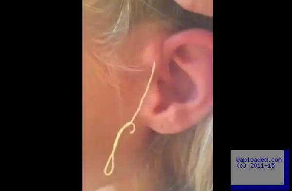 SEE What Came Out When Girl Popped Giant 6-Year Old Pimple